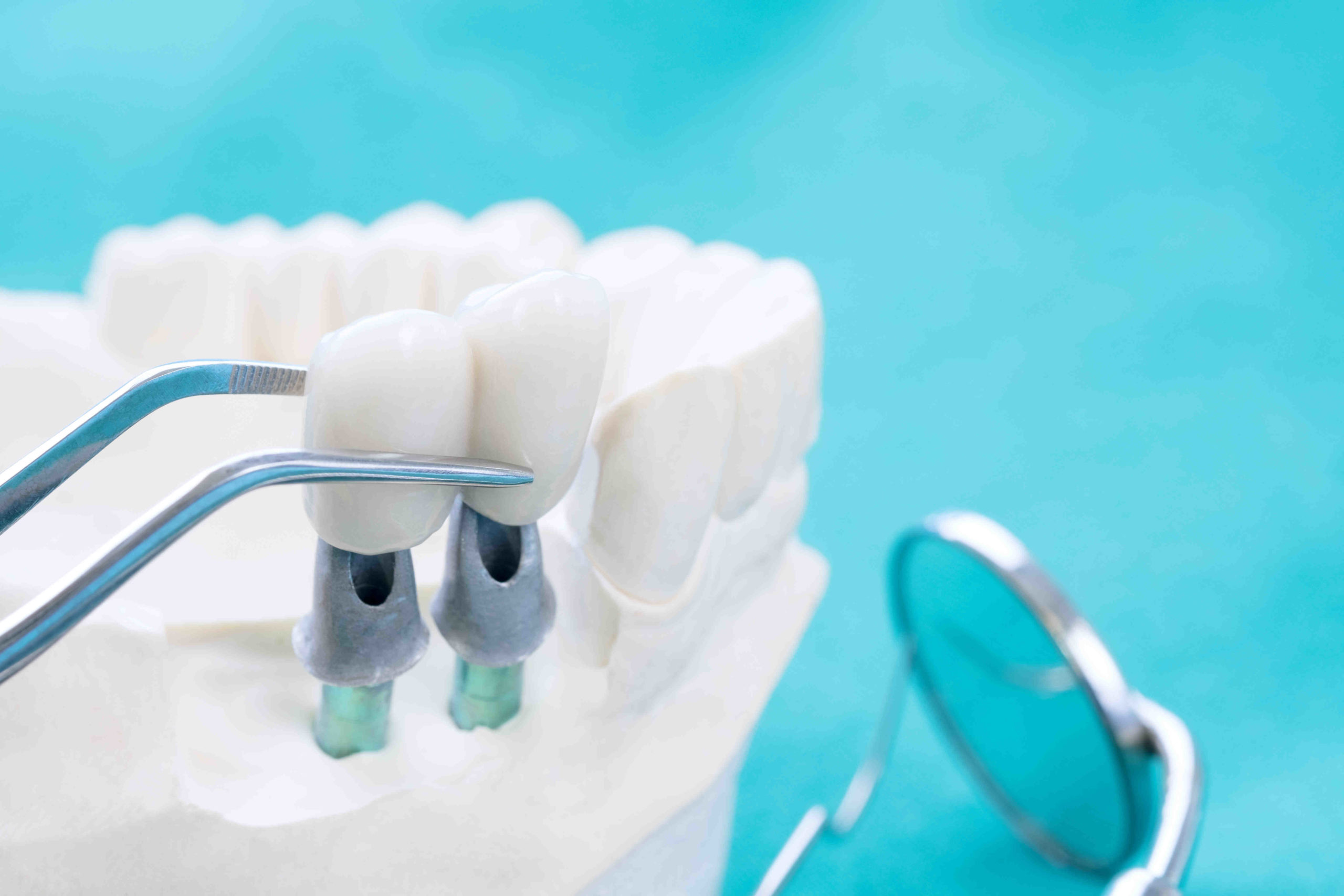 How much do dental implants cost in 2020?