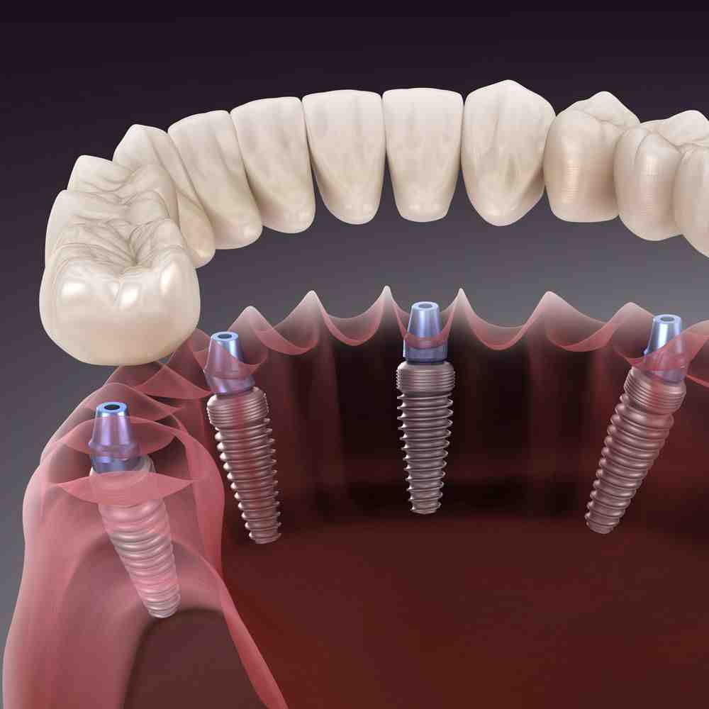 How Much Does Dental Implants Cost Per Tooth Dental News Network