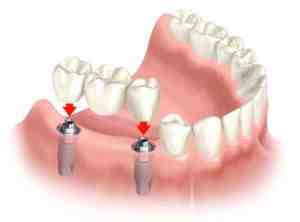 How much do dental implants cost in 2020?