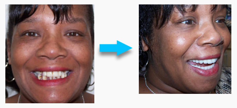 How much do dental implants cost in Kansas?