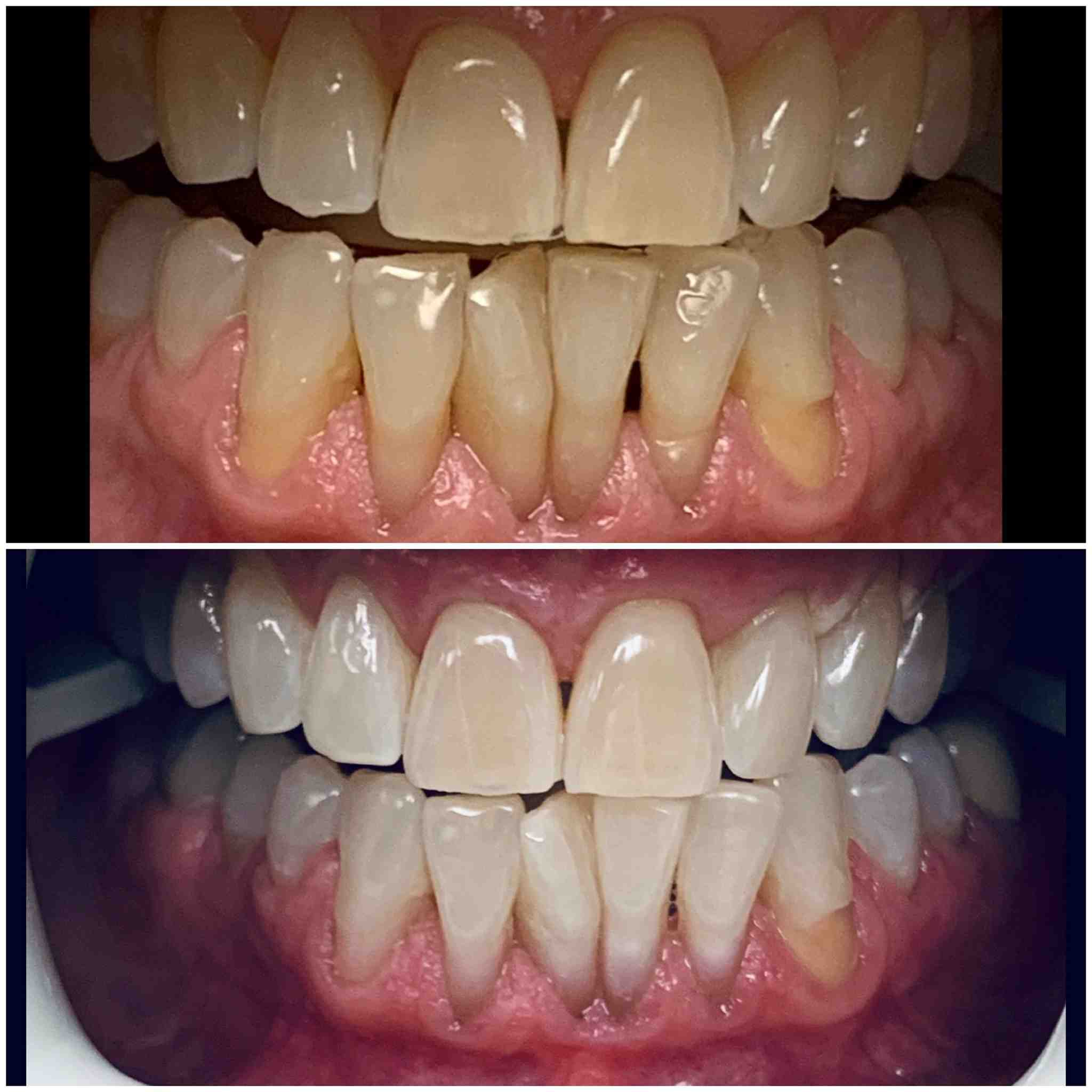 How much do dental implants cost in NJ?