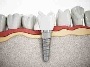 How much do dental implants cost in Ontario?