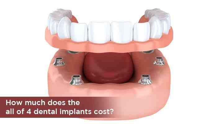 How much do dental implants cost in Ontario?