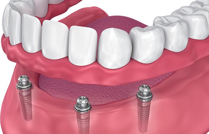 How Much Do Dental Implants Cost In Mexico