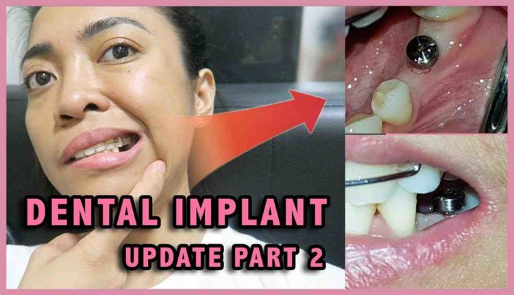 How much do dental implants cost per tooth
