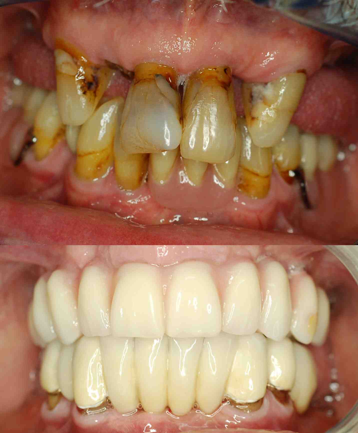 how-much-for-a-full-set-of-dental-implants-dental-news-network