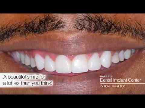 How much do full upper and lower dental implants cost?
