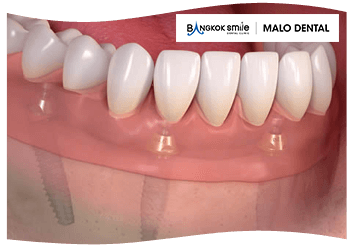 How much do full upper and lower dental implants cost?