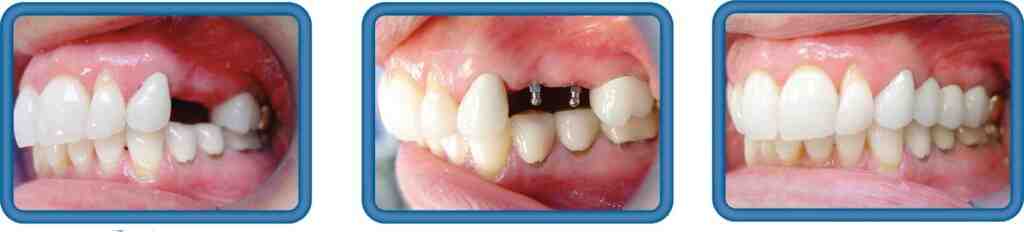 How much do mini tooth implants cost?