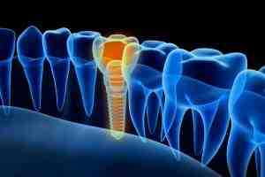 How much does Delta Dental cover for implants?