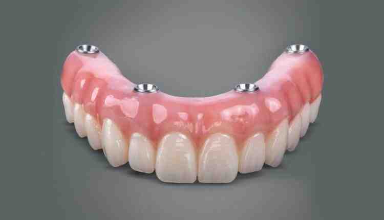 How much does a 4 in 1 dental implant cost?