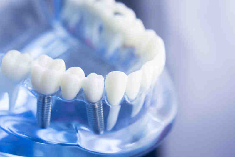 How much does a dental implant cost for one tooth?