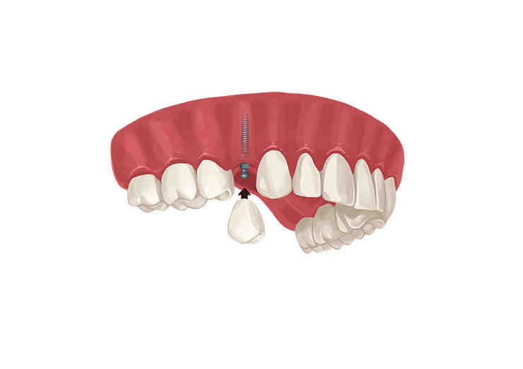 How much does a dental implant cost for one tooth?