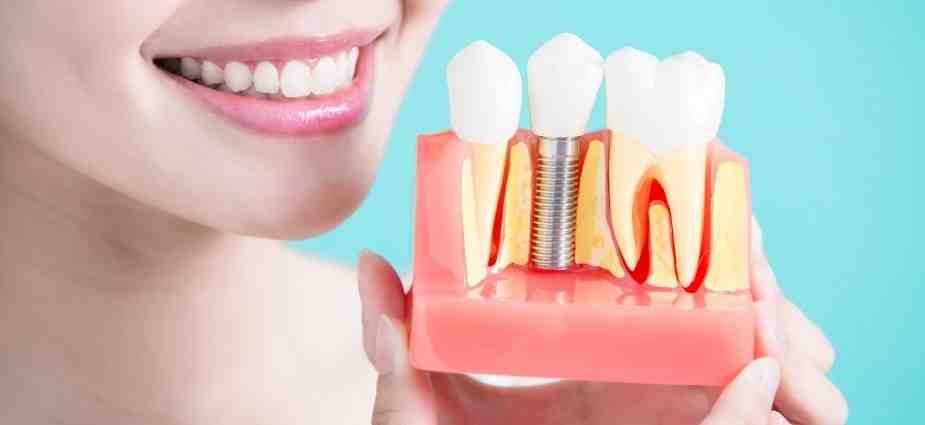 How much does a dental implant cost for one tooth?