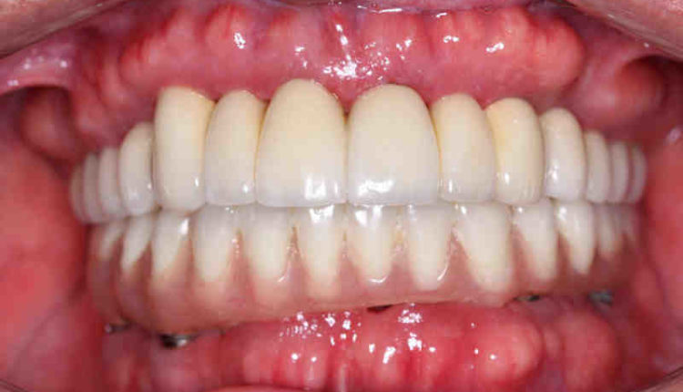 How much does a dental implant cost for one tooth?