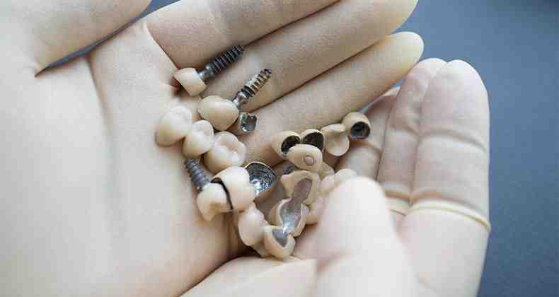 How much does a dental implant cost for one tooth?