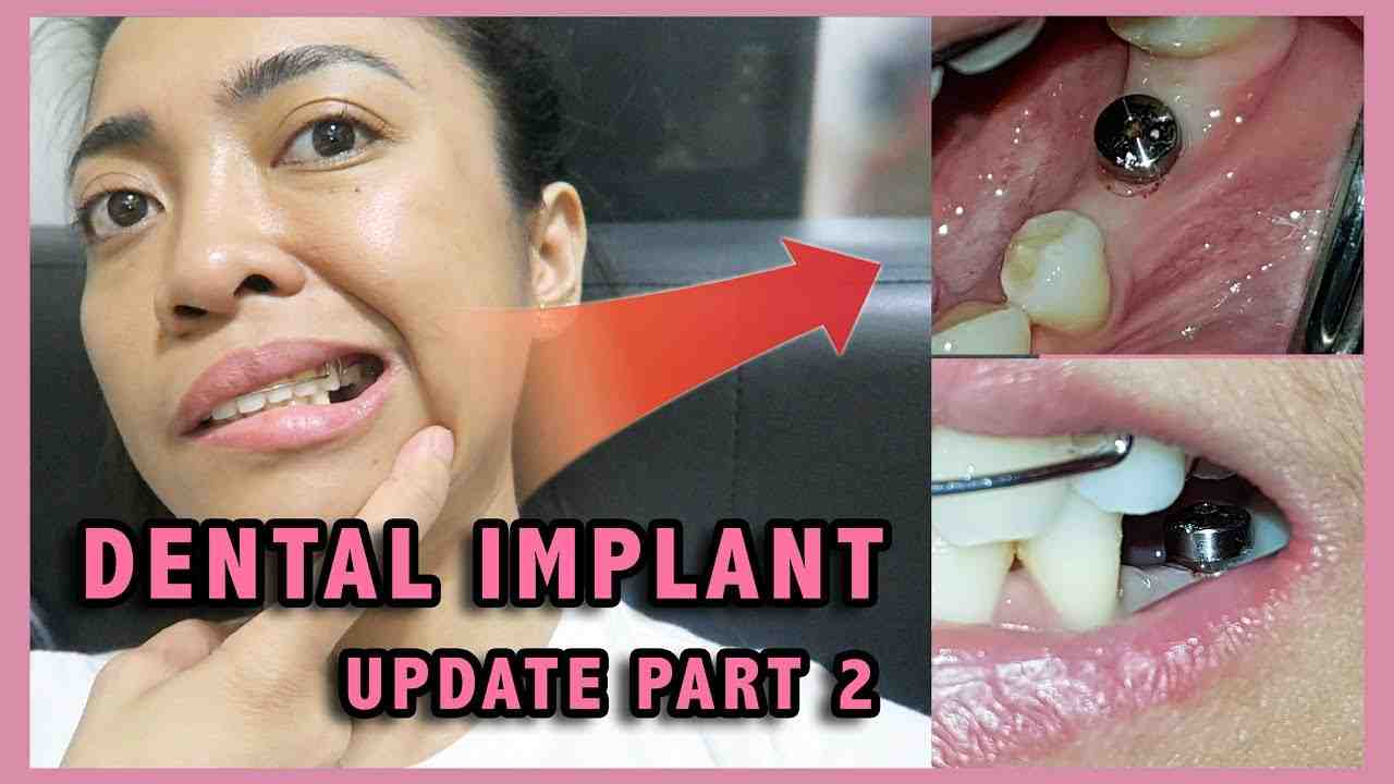 How Much For Dental Implants Dental News Network   How Much Does A Dental Implant Cost For One Tooth 5 