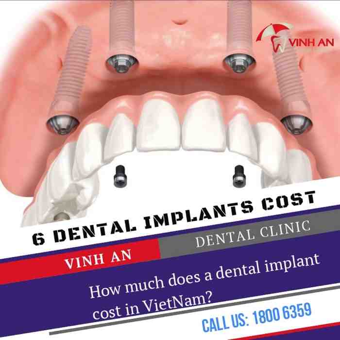 How much does a dental implant cost for one tooth?