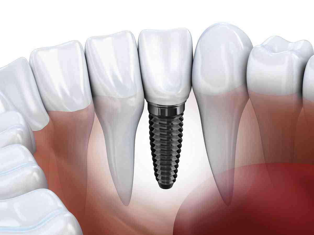 How much does a dental implant cost for one tooth?
