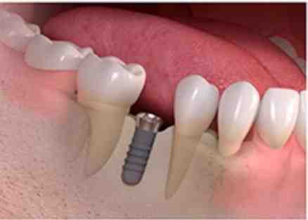 How much does a dental implant cost for one tooth?