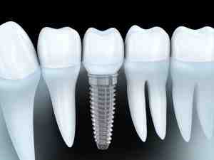 How much does a dental implant cost for one tooth?
