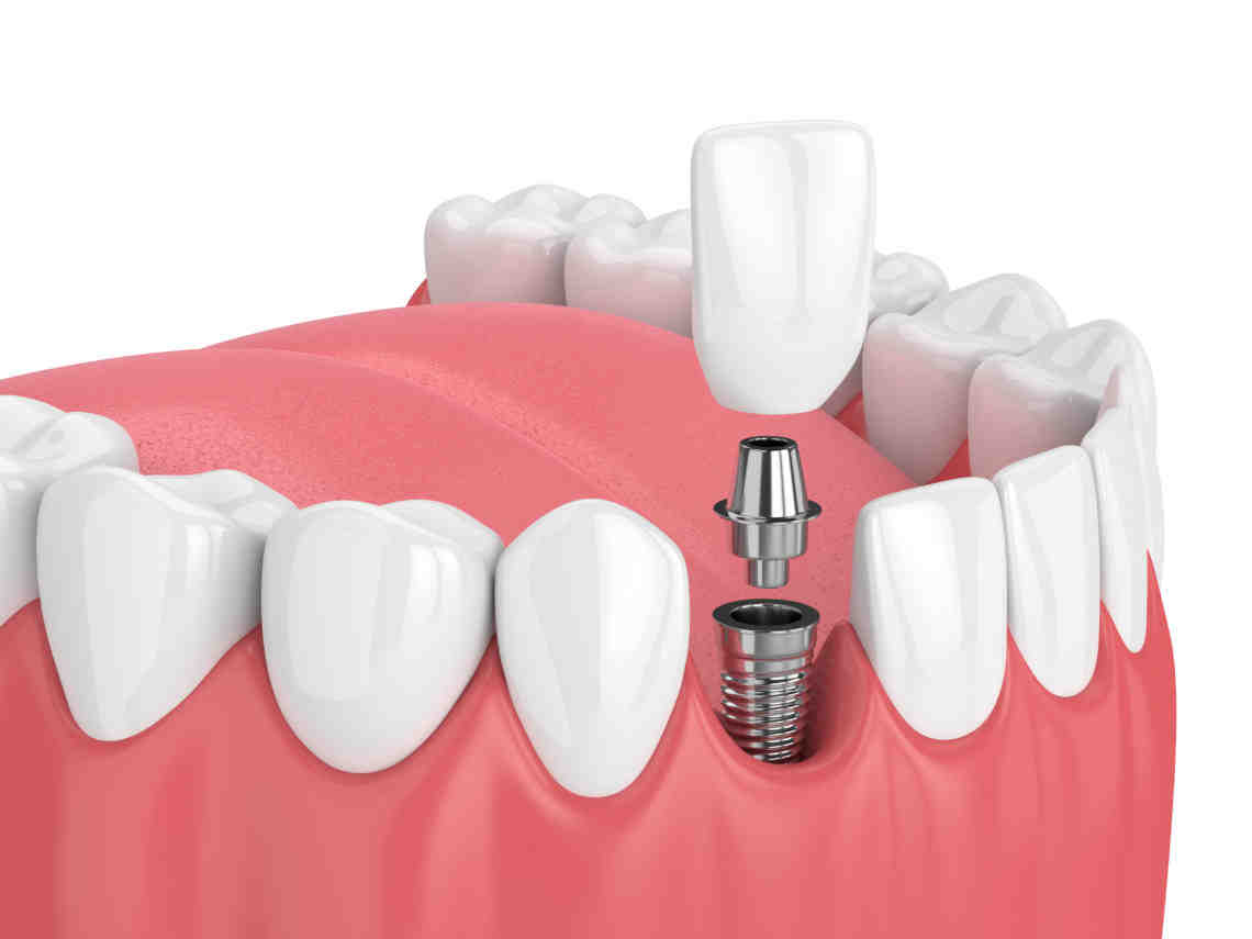 How much does a full mouth of dental implants cost?