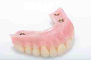 How much does a full mouth of dental implants cost?