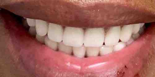 How much does a full set of dental implants cost?