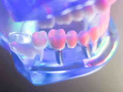 How much does a full set of dental implants cost?