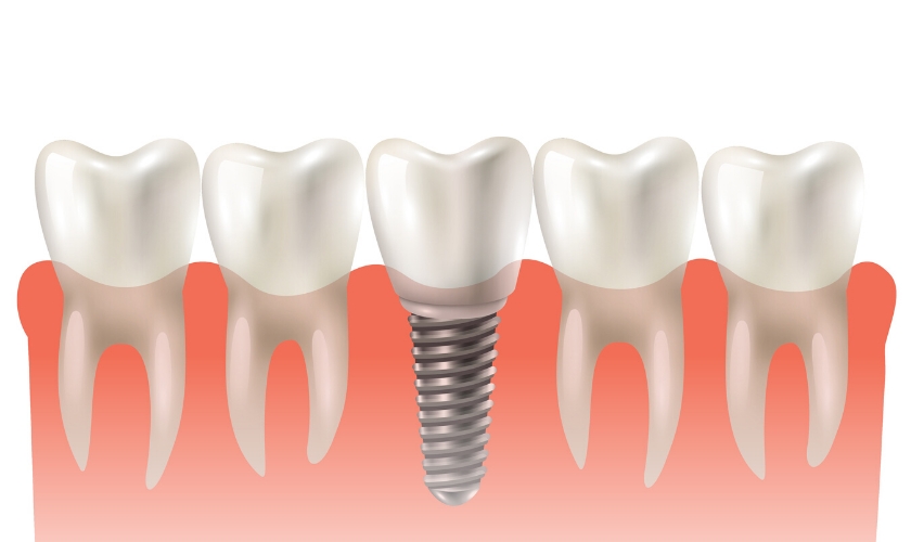 How much does a full set of dental implants cost?