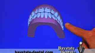 How much does a tooth implant cost in Massachusetts?