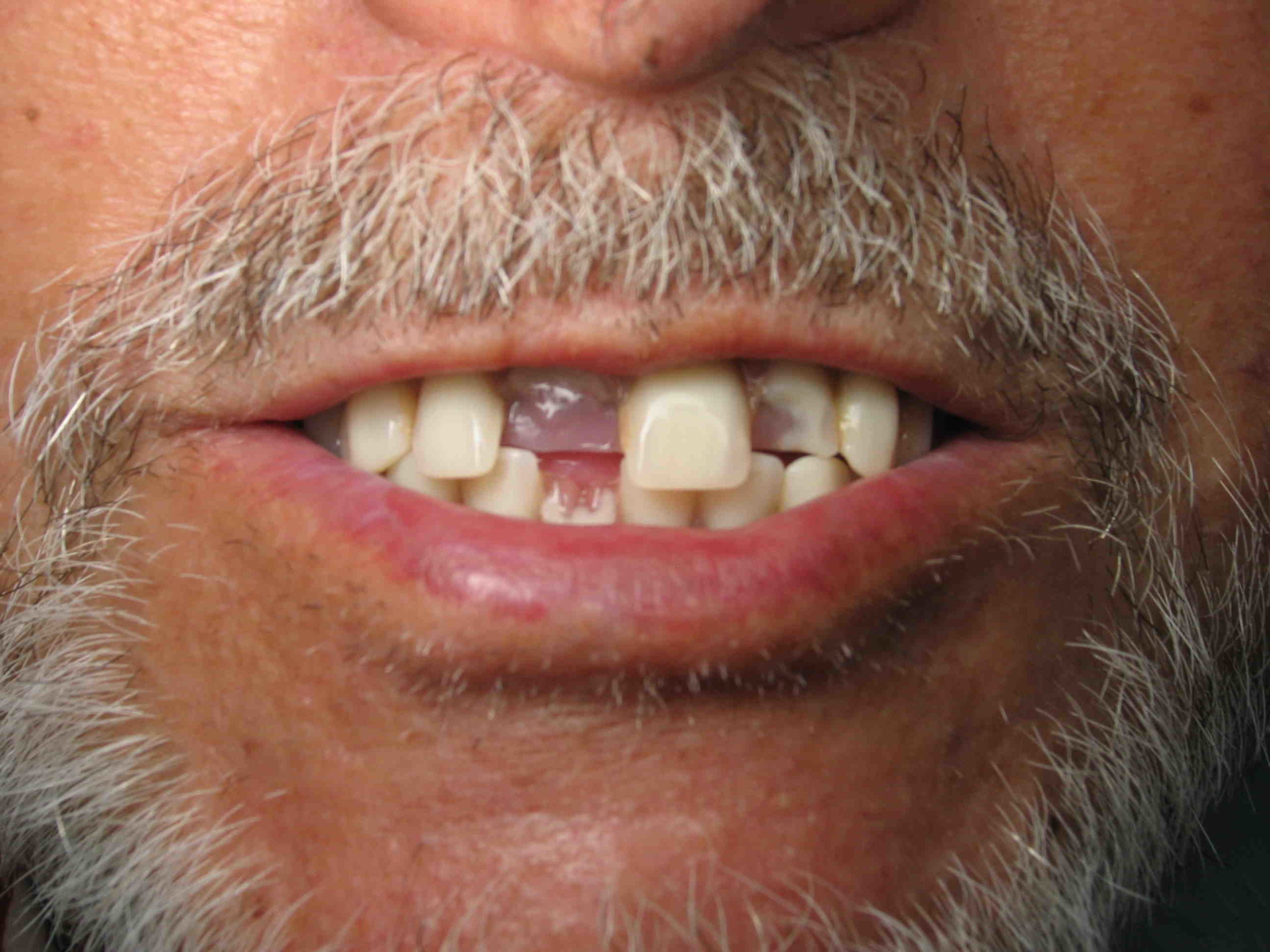 How much does a tooth implant cost with insurance?