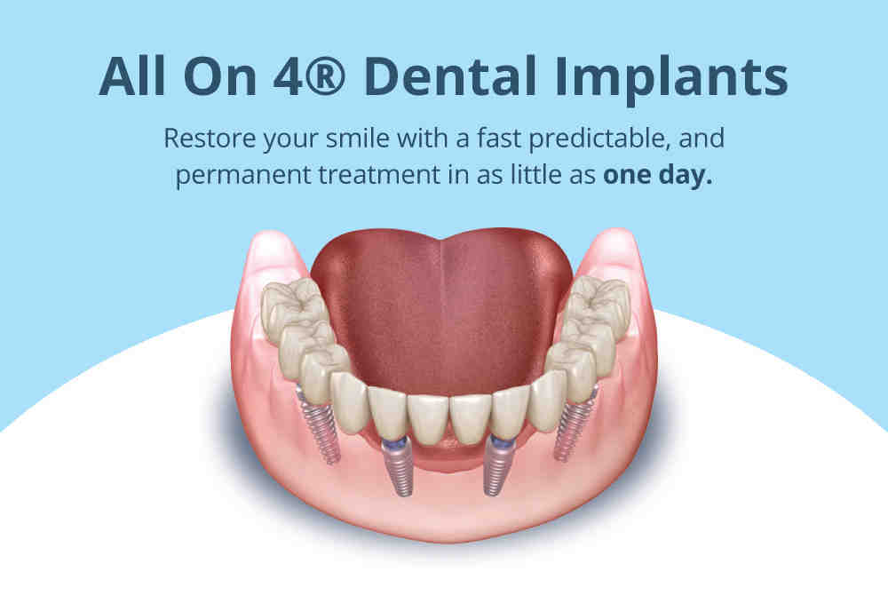 How much does the all on 4 dental implant cost? - Dental News Network