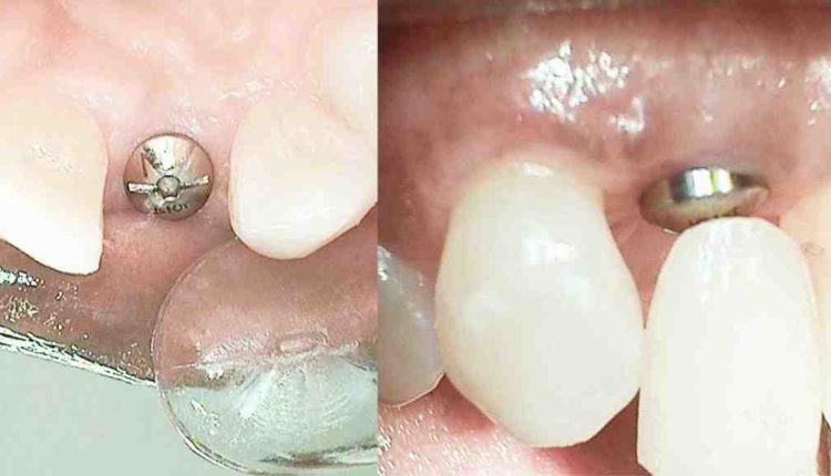How much does dental implants cost