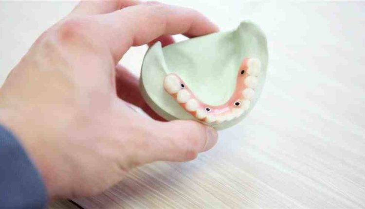 How much does full dental implants cost