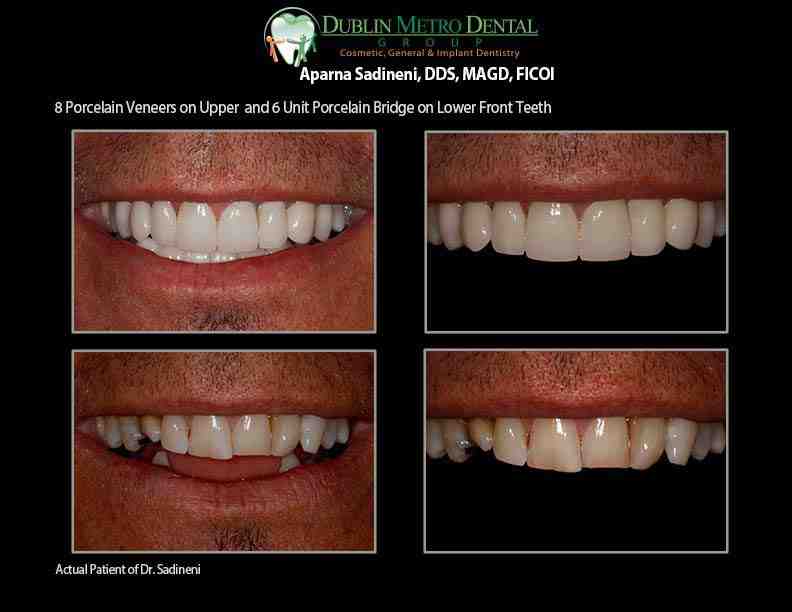 How much does implants cost per tooth?