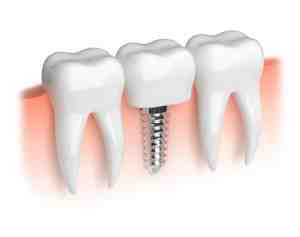 How much does insurance pay for dental implants?