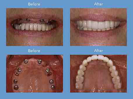 How much does insurance pay for dental implants?