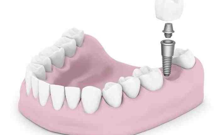 How much does it cost for dental implants