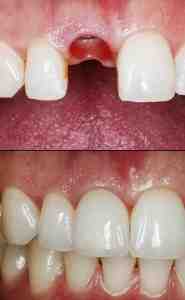 How much does it cost to fix your teeth in Mexico?