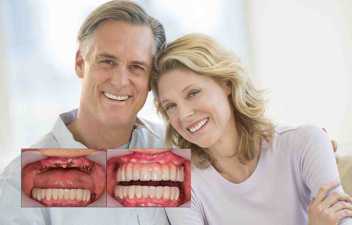 How much does it cost to get a full mouth of dental implants in Canada?