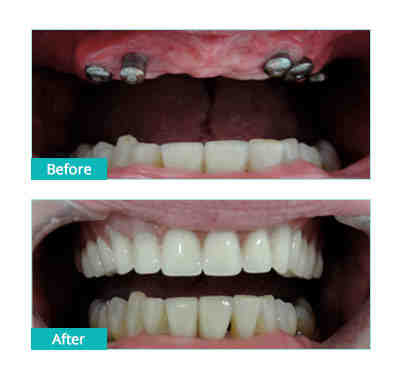 How much does it cost to get a full mouth of dental implants in Canada?