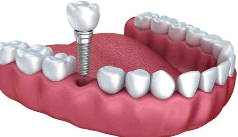 How much does it cost to get a full mouth of dental implants with insurance?