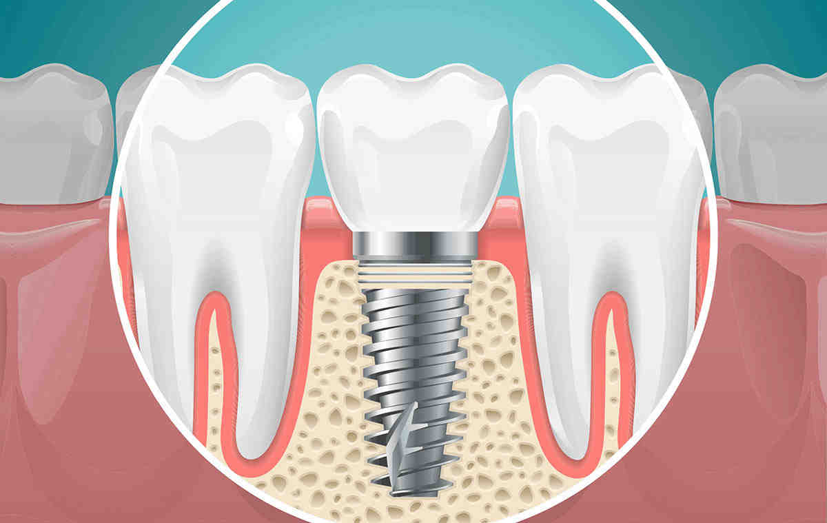 How much does it cost to get a full mouth of dental implants with insurance?