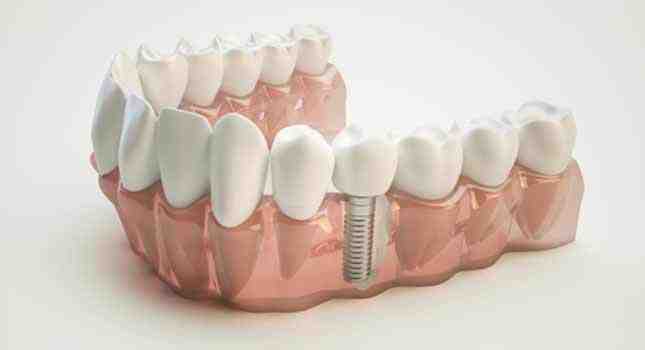 How much does it cost to pull all teeth and get implants?