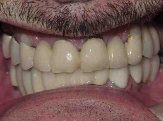How much does it cost to replace all your teeth?
