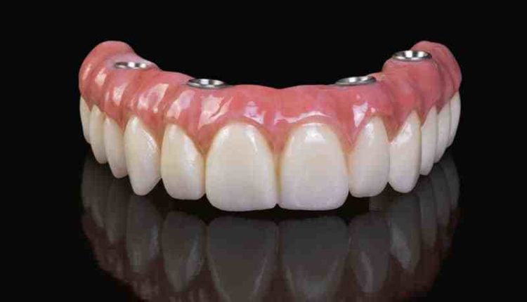 How much does the all on 4 dental implant cost?