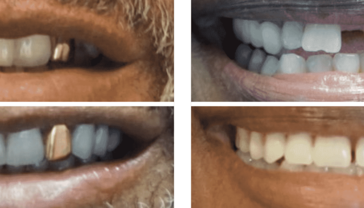 How much for dental implants