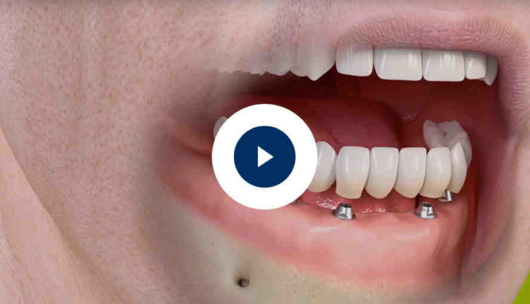 How much for full dental implants