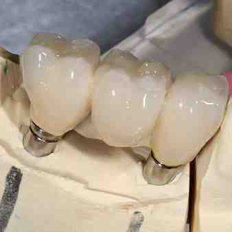 How much is a bridge for 3 teeth?
